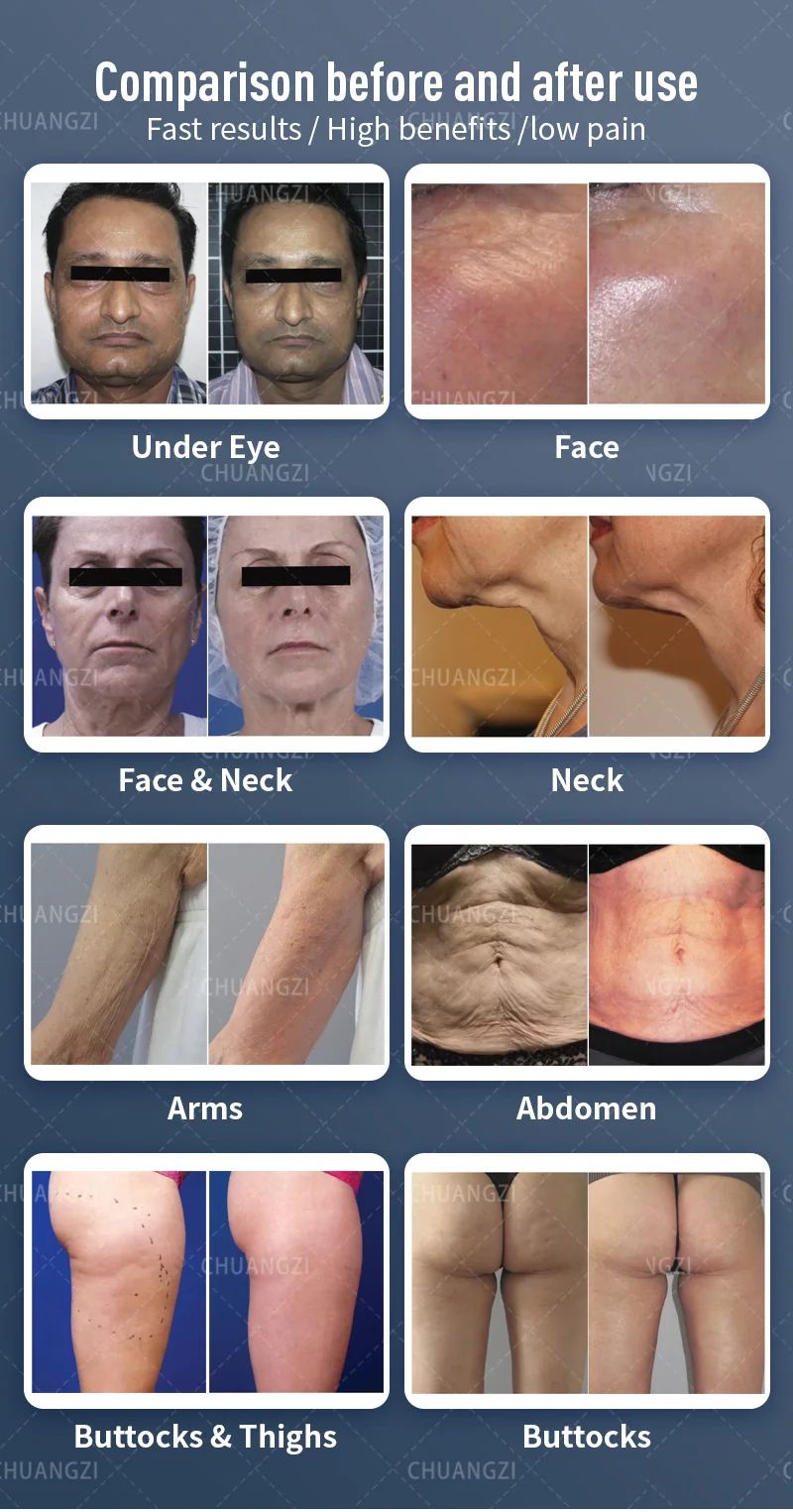 Professional multi-function wrinkle removal. Lose weight. Firms the skin. Integrated machine. We sell at factory price.