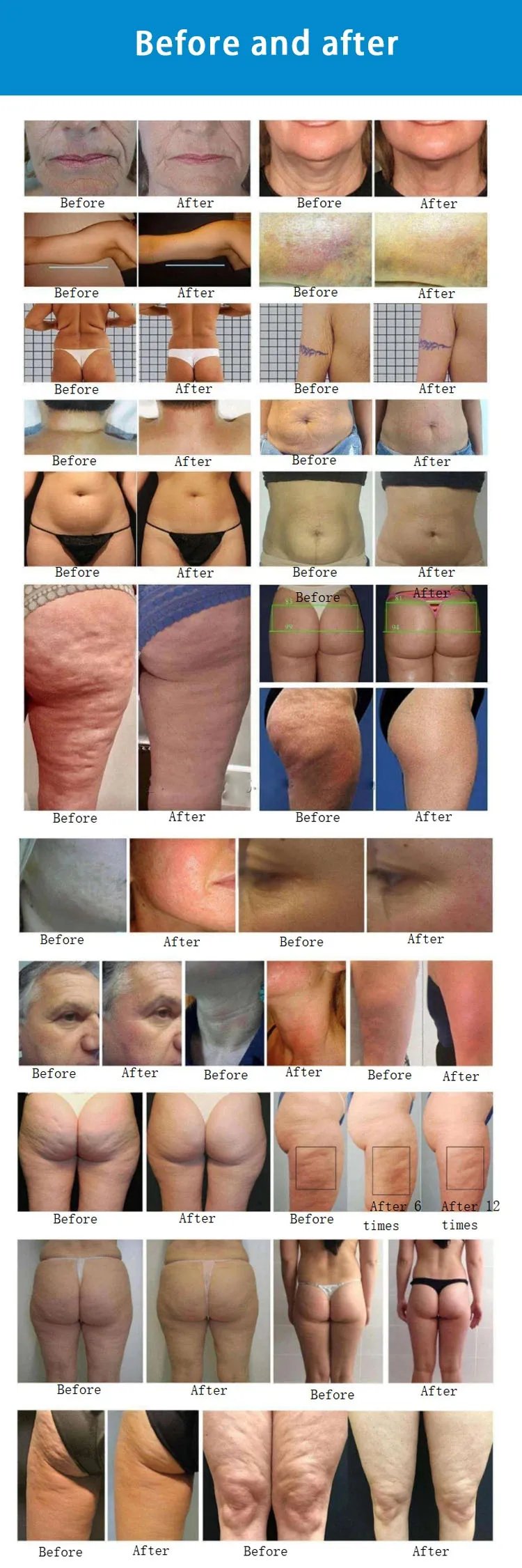 Portable Blood Circulation Face Lifting Weight Loss Body Slim Rotary Negative Pressure RF Inner Ball Roller V-Shaping Machine Portable Blood Circulation Face Lifting Weight Loss Body Slim Rotary Negative Pressure RF Inner Ball Roller V-Shaping Machine