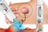 Lipoma Removal Laser Pointer Efficiently Removes Lipoma Fibroids Subcutaneous Lumps Body Health Care