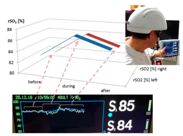 Transcranial Magnetic Brain Photobiomodulation Infrared 810nm Neurofeedback Therapy Machine Pdt Treatment Photodynamic